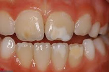 Παιδοδοντίατρος Βίκυ Ορ. Τασιούλα Οδοντίατρος Α.Π.Θ., ειδικευθείσα στην Παιδοδοντιατρική M Dent Sci Leeds Dental Institute, UK | Οδοντίατρος για παιδιά, εφήβους και ειδικούς ασθενείς | Πάροδος Γ. Ολυμπίου 1, 60132 Κατερίνη | Παιδοδοντίατρος στην Κατερίνη, Οδοντίατρος για παιδιά στην Κατερίνη, paidodontiatros katerini