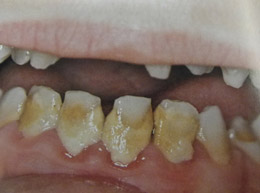 Παιδοδοντίατρος Βίκυ Ορ. Τασιούλα Οδοντίατρος Α.Π.Θ., ειδικευθείσα στην Παιδοδοντιατρική M Dent Sci Leeds Dental Institute, UK | Οδοντίατρος για παιδιά, εφήβους και ειδικούς ασθενείς | Πάροδος Γ. Ολυμπίου 1, 60132 Κατερίνη | Παιδοδοντίατρος στην Κατερίνη, Οδοντίατρος για παιδιά στην Κατερίνη, paidodontiatros katerini